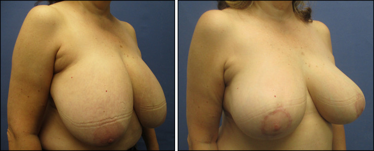 BreastReduction